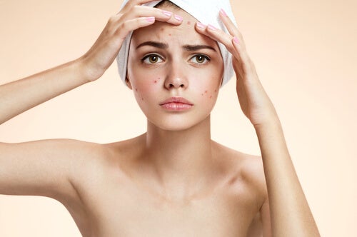 5 remedios caseros para combatir el acné