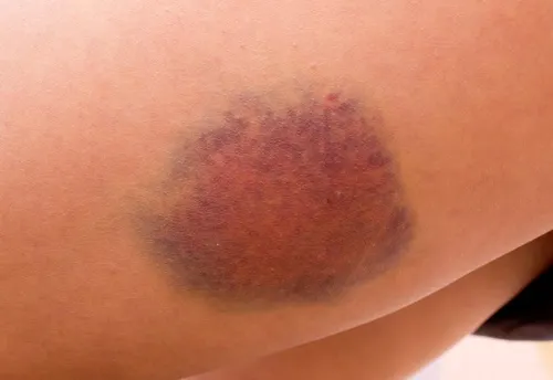 Aplicación tópica de pulpa de papaya ayuda a reducir los golpes y hematomas de la piel