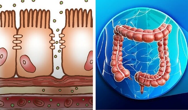 Qué es un intestino permeable y cómo puede afectar tu salud