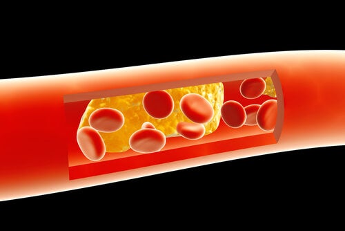 Arteriosclerosis: qué es y cómo combatirla con remedios naturales