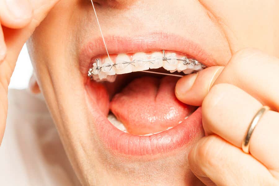 Usar hilo dental con la ortodoncia.