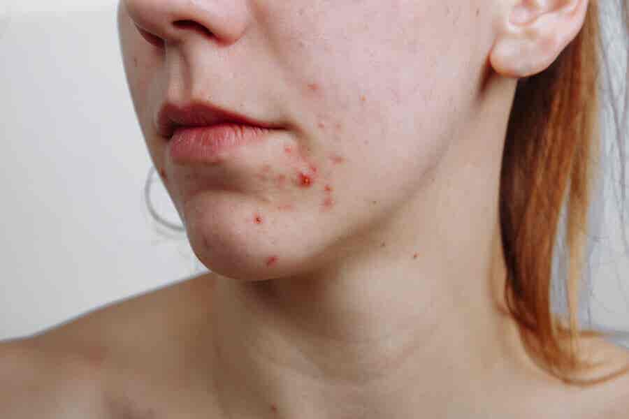 El acné aparece si no estás bien de salud