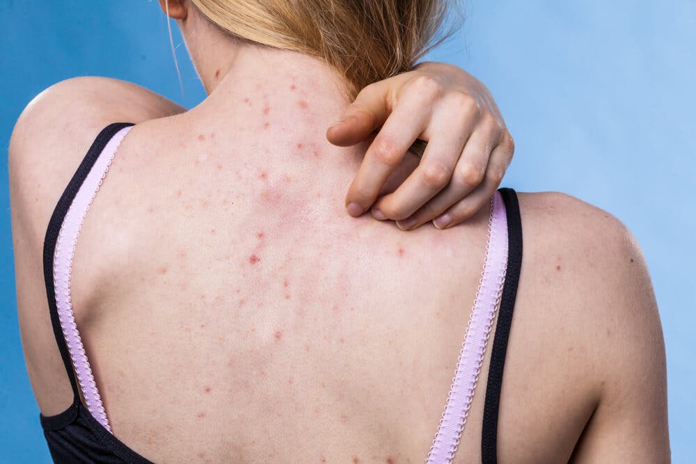 Los desequilibrio hormonal y la aparición de acné