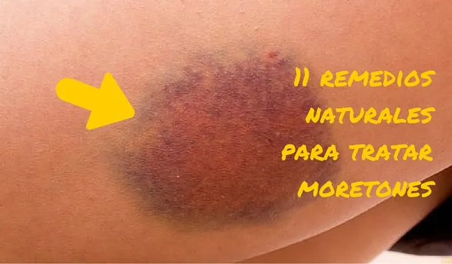 11 remedios naturales para tratar moretones