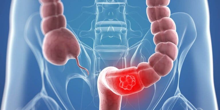 ¿Remedios naturales que ayudan en el tratamiento del cáncer de colon?
