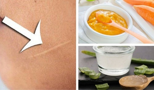 Cómo disminuir las cicatrices de tu piel de forma natural