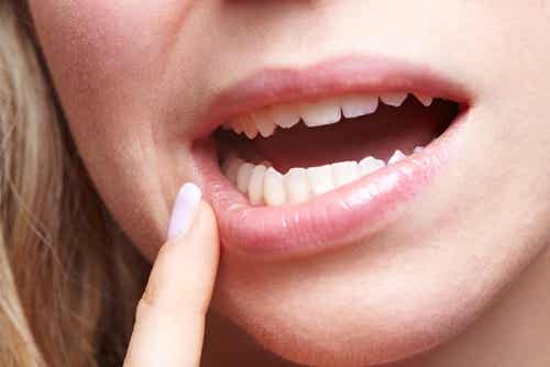 El deterioro dental puede deberse a una malnutrición.