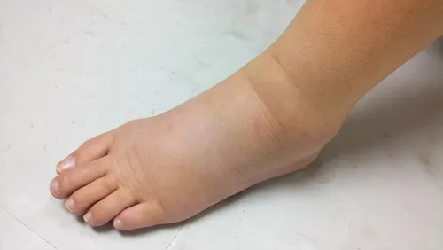 Edema o inflamación