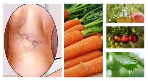Tratamiento natural para las várices con aloe vera, zanahoria y vinagre de manzana