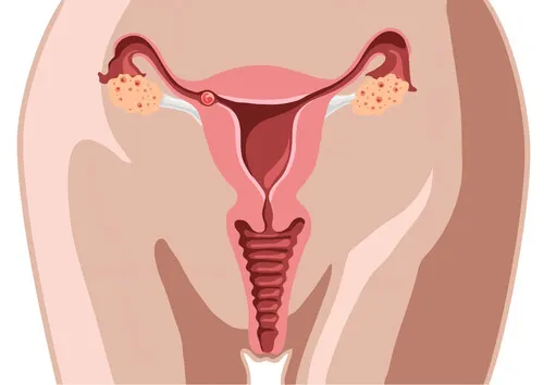 cáncer de cuello uterino