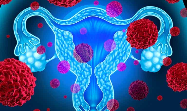 Cáncer de endometrio: 5 aspectos que se deben tener en cuenta