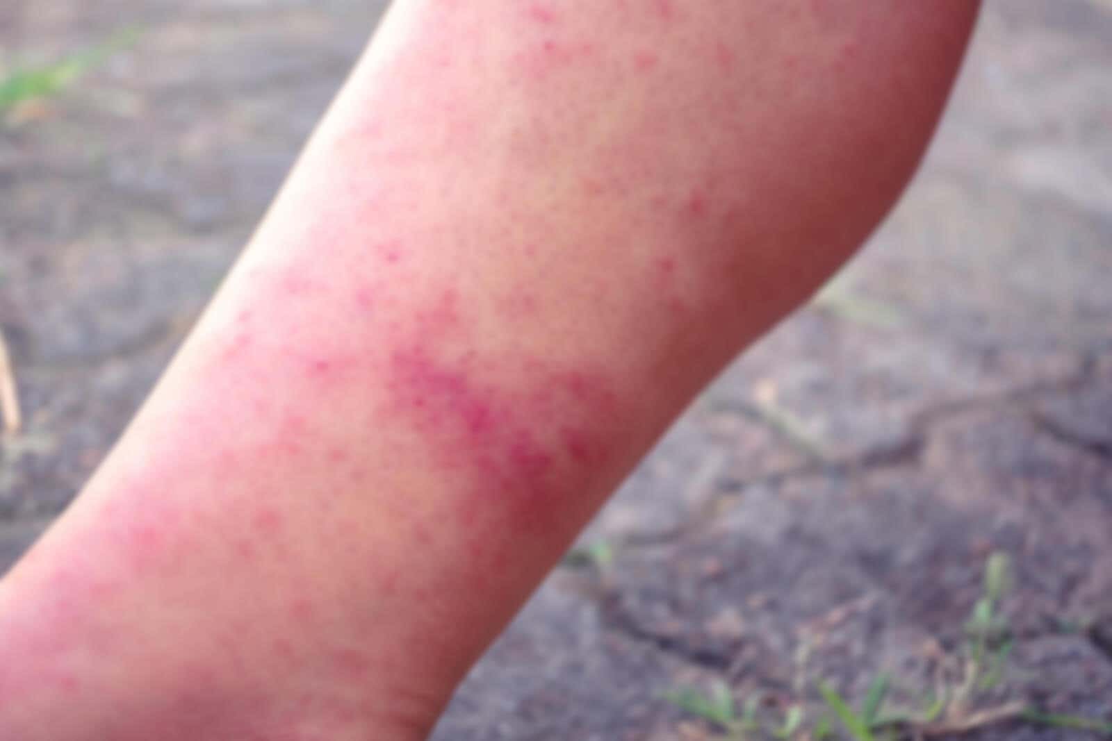 Dermatitis en la pierna por depilación con cera.