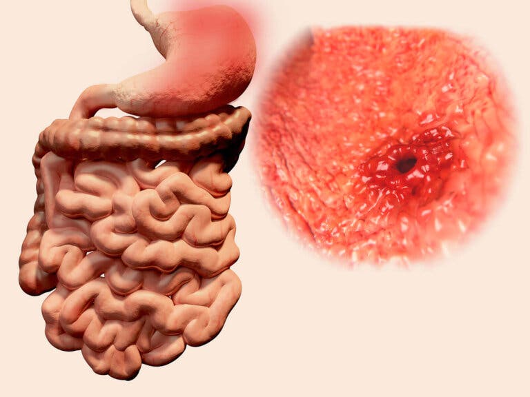 ¿Qué es la gastritis erosiva? Síntomas, causas y tratamiento