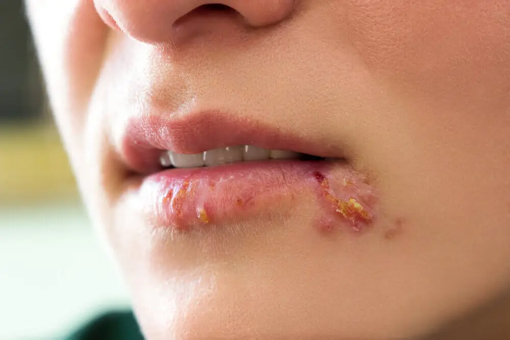 Herpes en los labios