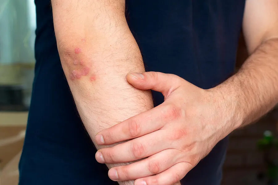 Homme atteint de psoriasis sur le bras.