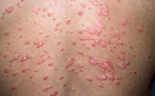 ¿Cuáles son los tipos de psoriasis?