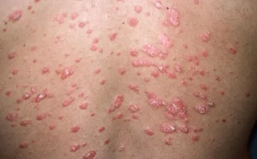 ¿Cuáles son los tipos de psoriasis?