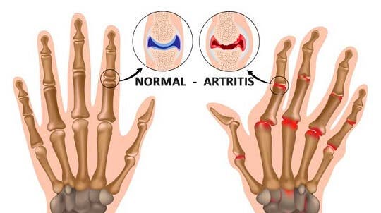 5 cosas que probablemente no sabías de la artritis