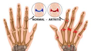 5 cosas que probablemente no sabías de la artritis