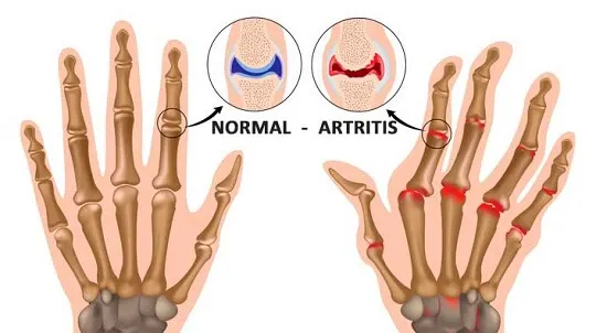 5 cosas que probablemente no sabías de la artritis