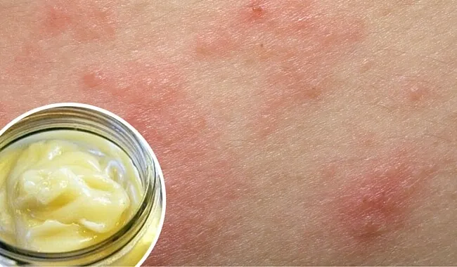 Crema facial casera para pieles con dermatitis