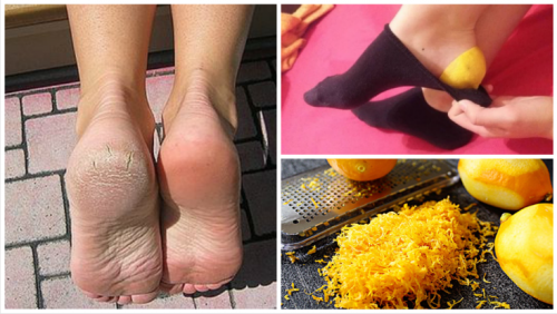 Descubre por qué deberías poner cáscara de limón en tus pies antes de ir a dormir