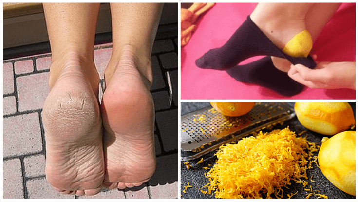 Descubre por qué deberías poner cáscara de limón en tus pies antes de ir a dormir