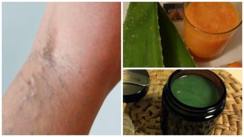 Alivia las venas varices con esta antigua receta de la abuela
