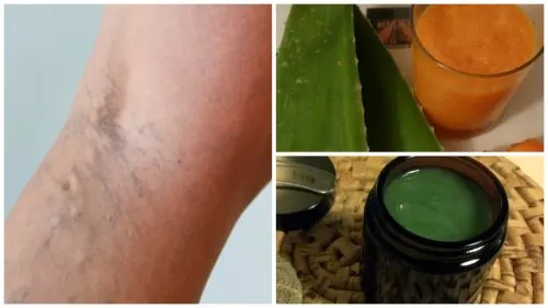 Alivia las venas varices con esta antigua receta de la abuela