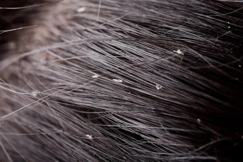 Remedios naturales para combatir la caspa seca y grasa