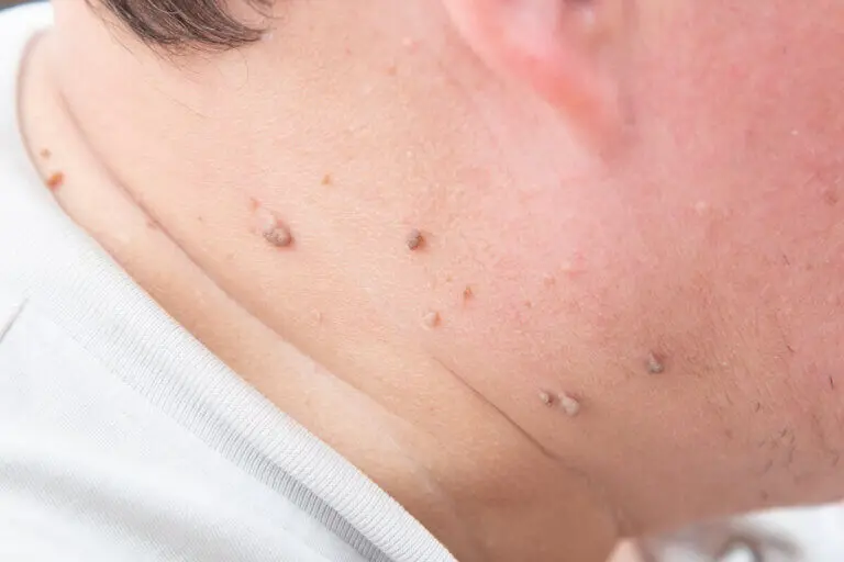 6 consejos para eliminar naturalmente los acrocordones