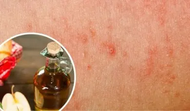 ¿Cómo eliminar los hongos de la piel con remedios hechos en casa?
