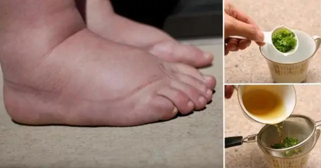 Este es uno de los mejores remedios para aliviar la hinchazón de los pies