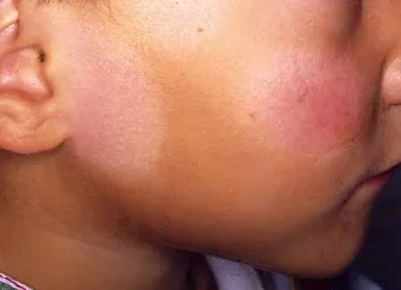 pitiriasis-alba