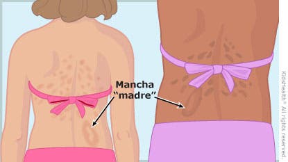 Pitiriasis: una erupción cutánea muy común
