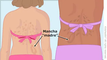 Pitiriasis: una erupción cutánea muy común