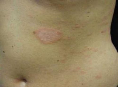 pityriasis