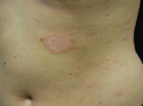 pityriasis