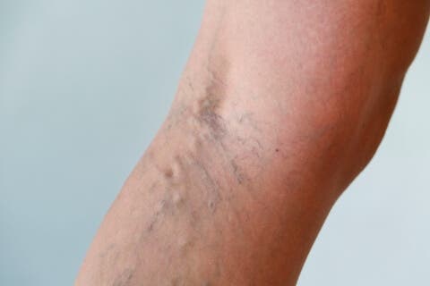 Varices