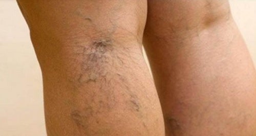 6 curiosidades que debes saber sobre las venas varicosas