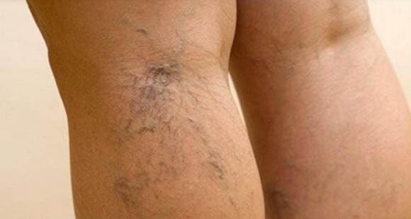 6 curiosidades que debes saber sobre las venas varicosas