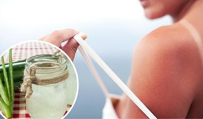 5 remedios con aloe vera para calmar las quemaduras solares