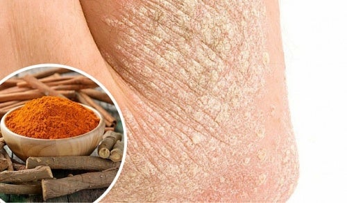 6 tips para superar la psoriasis de manera natural