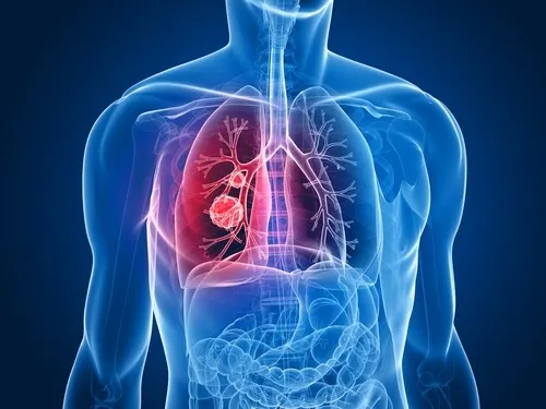 Cáncer de pulmón
