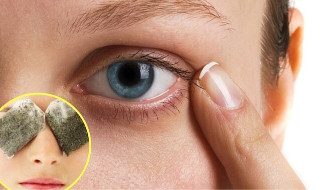 Cómo eliminar las ojeras bajo los ojos con remedios caseros