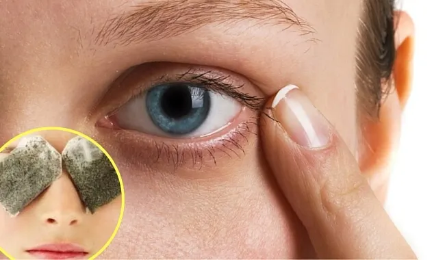 7 remedios naturales y efectivo para tratar las ojeras
