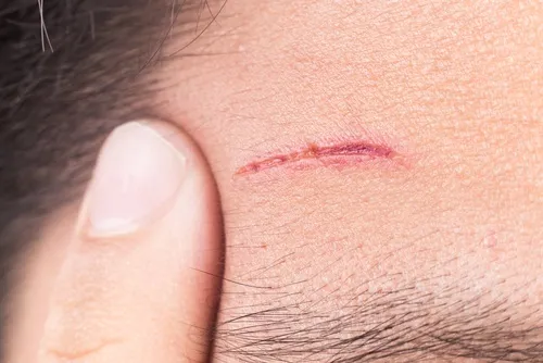 Dificultad para cicatrizar