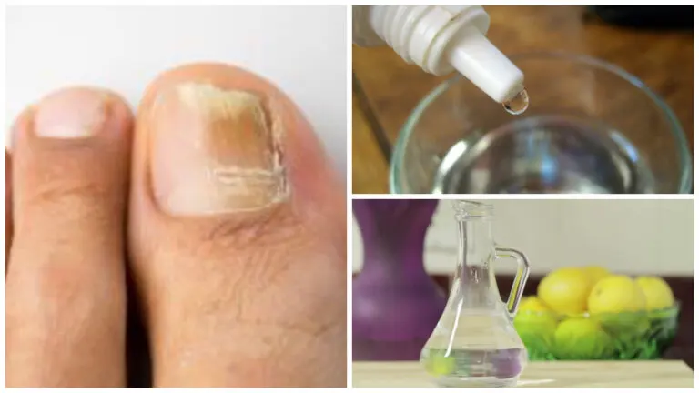 Fabrica tu propio rompehongos natural para las uñas