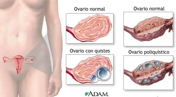 5 datos sobre los quistes ováricos que toda mujer debe saber