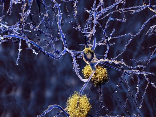 Tipos de demencia que no son Alzheimer